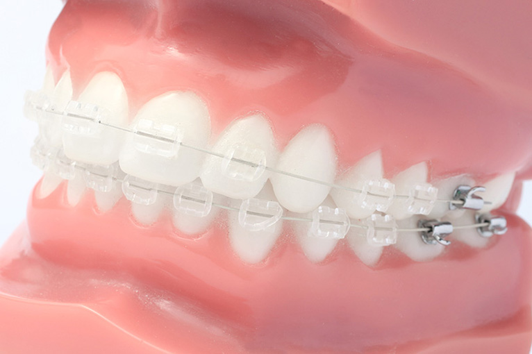 ortodoncia invisible dentista leganes
